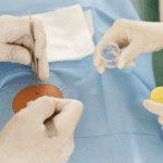 Novo implante ajuda o corpo a combater o câncer, inclusive com metástase, anunciam cientistas